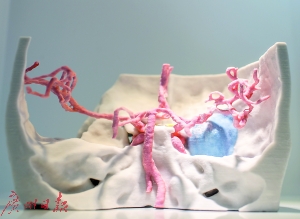 邁普再生醫(yī)學展示的3D打印顱頸交界腫瘤模型。